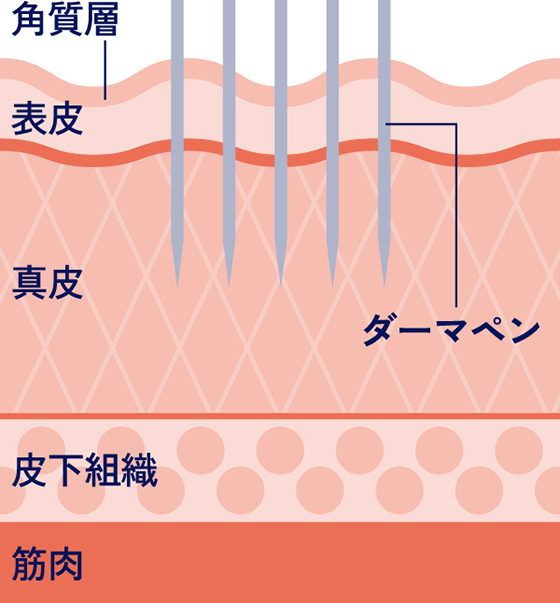 超極細針で肌に微細な穴を形成