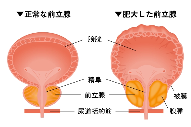 前立腺肥大症（BPH）とは