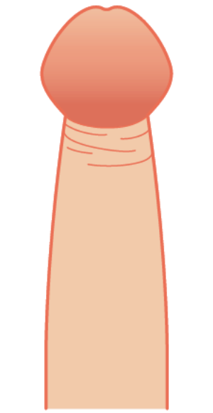 3. 嵌頓（かんとん）包茎